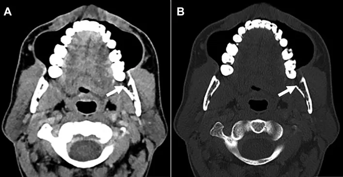 A patient, who was diagnosed with Stage IV Colorectal Adenocarcinoma