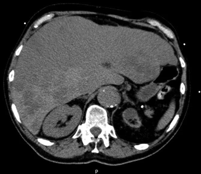 A patient, who was diagnosed with Stage IV Small Cell Lung Cancer