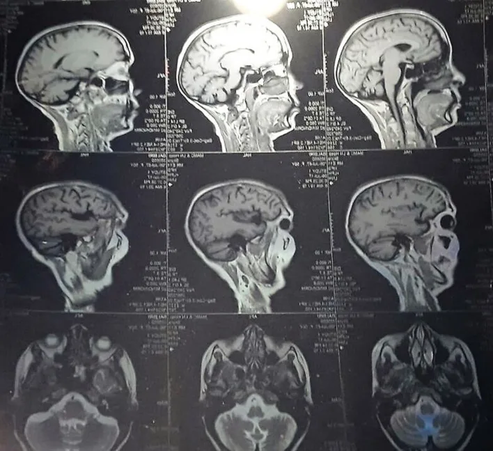 A patient, who was diagnosed with Stage II Invasive Ductal Carcinoma