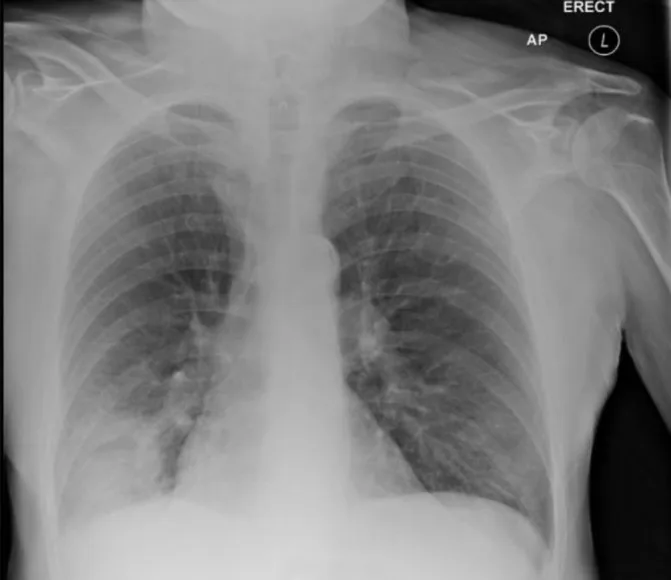 A patient, who was diagnosed with Stage IV Lung Adenocarcinoma