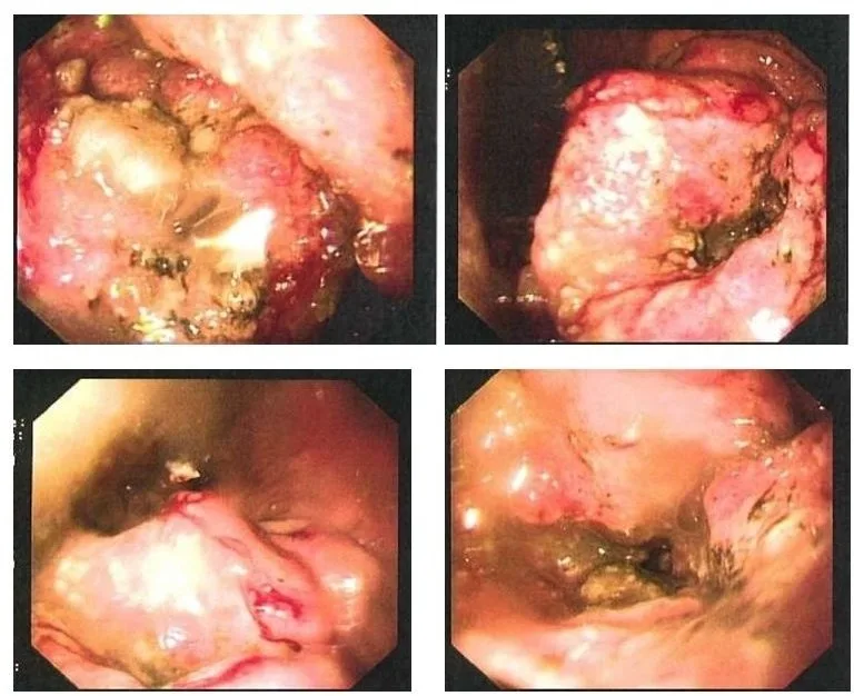 A patient, who was diagnosed with Stage IV Gastric Adenocarcinoma