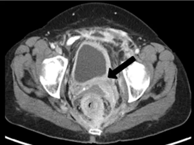 A patient, who was diagnosed with Stage IV Invasive Ductal Carcinoma