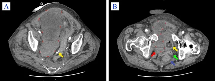 A patient, who was diagnosed with Stage III Colorectal Adenocarcinoma