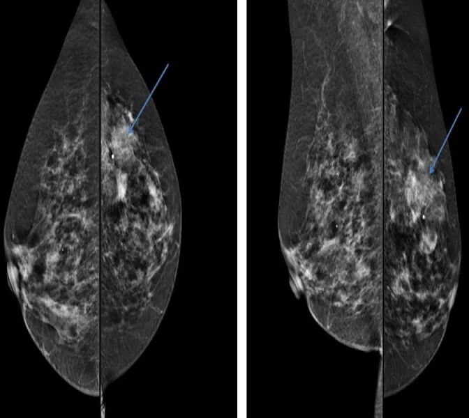 A patient, who was diagnosed with Breast Cancer
