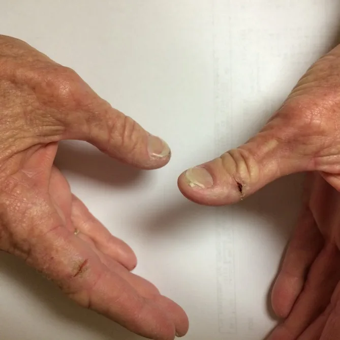 A patient, who was diagnosed with Stage IV Colorectal Cancer