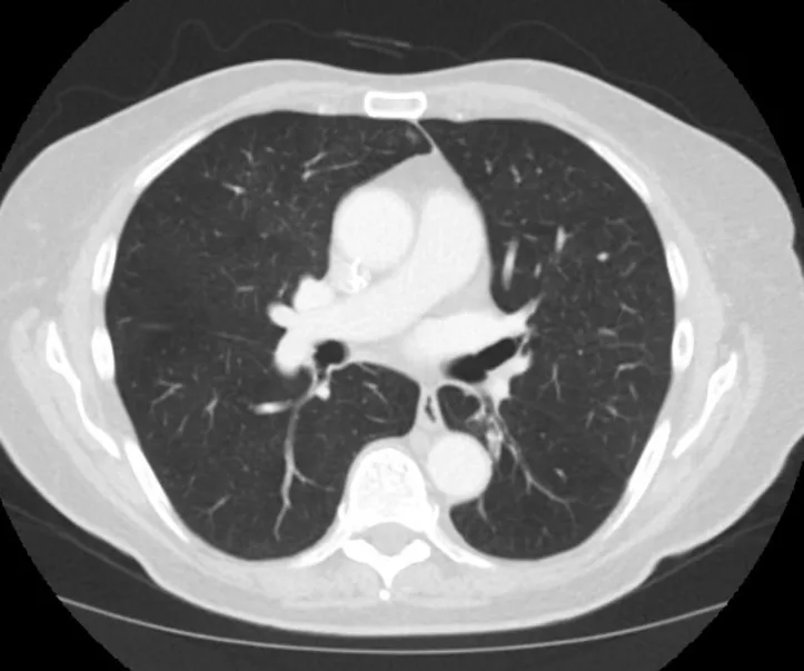 A patient, who was diagnosed with Stage IV Lung Adenocarcinoma