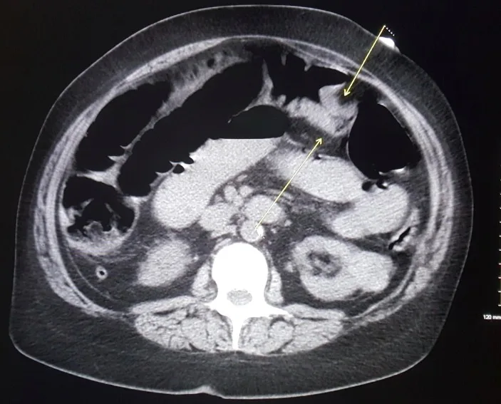 A patient, who was diagnosed with Colorectal Cancer