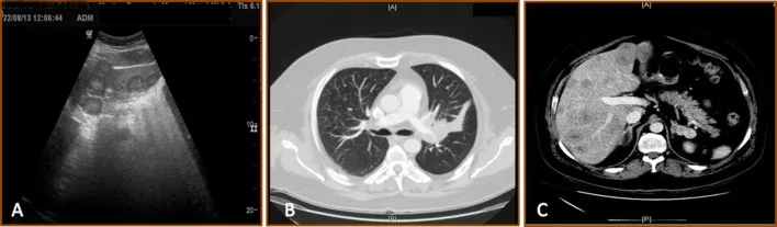 A patient, who was diagnosed with Stage IV Small Cell Lung Cancer
