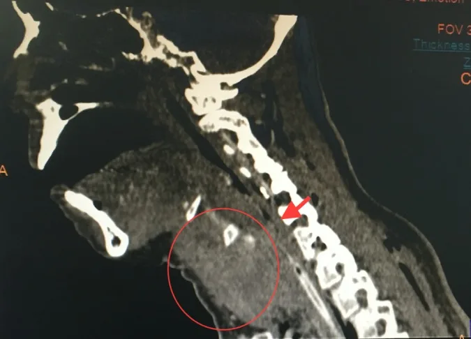 A patient, who was diagnosed with Colorectal Adenocarcinoma