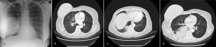 A patient, who was diagnosed with Invasive Ductal Carcinoma