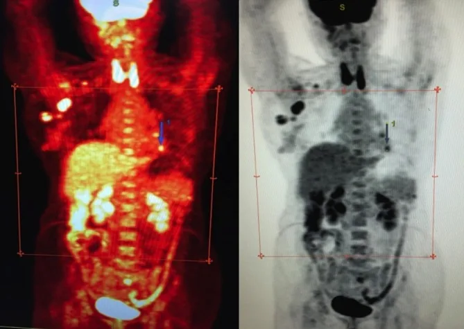 A patient, who was diagnosed with Invasive Ductal Carcinoma