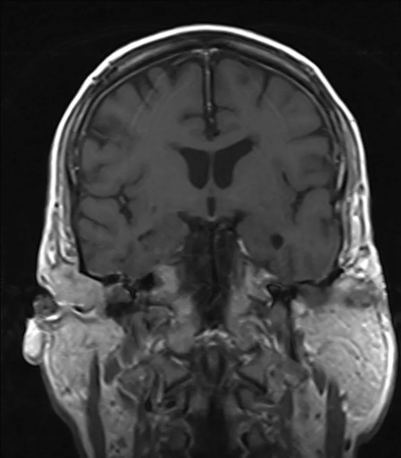 A patient, who was diagnosed with Colorectal Adenocarcinoma