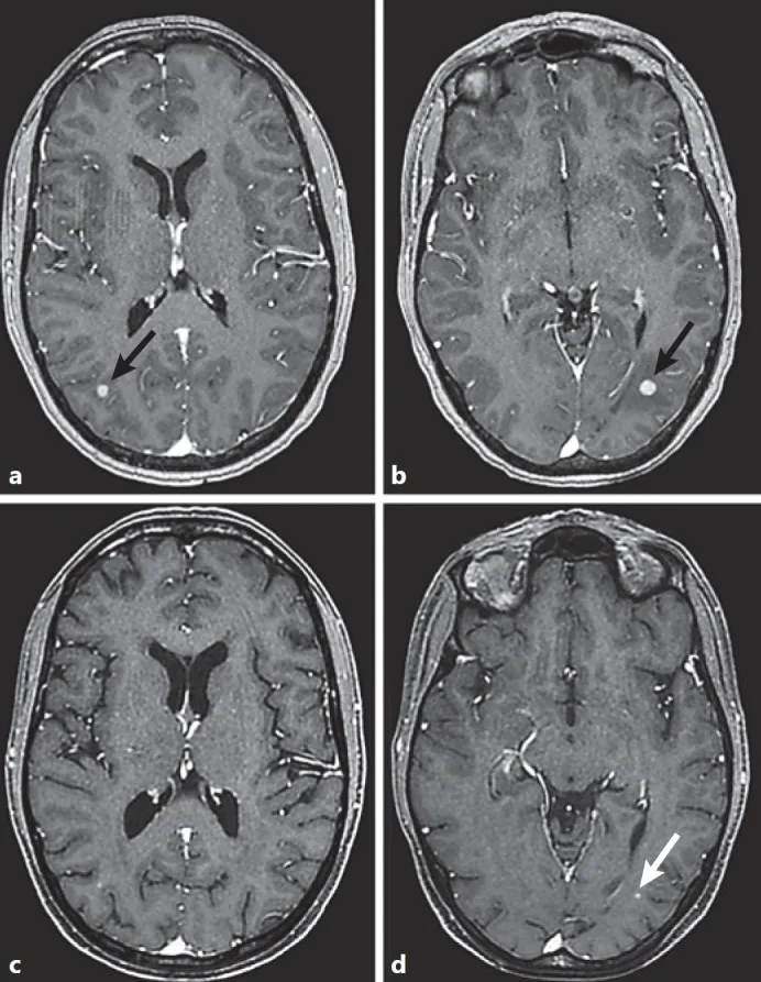 A patient, who was diagnosed with Stage IV Invasive Ductal Carcinoma