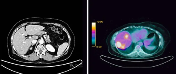 A patient, who was diagnosed with Stage IV Invasive Lobular Carcinoma