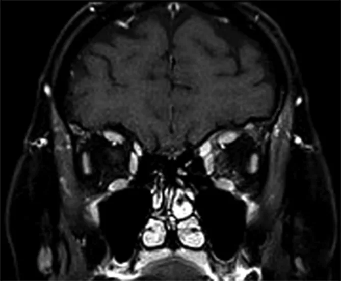 A patient, who was diagnosed with Invasive Lobular Carcinoma
