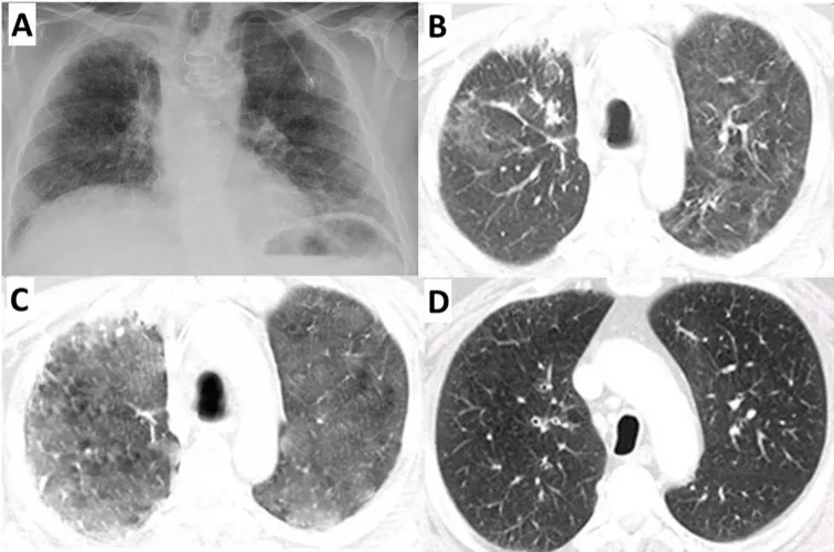 A patient, who was diagnosed with Stage IV Lung Adenocarcinoma