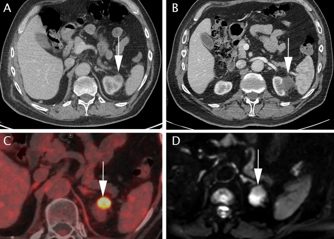 A patient, who was diagnosed with Lung Squamous Cell Carcinoma
