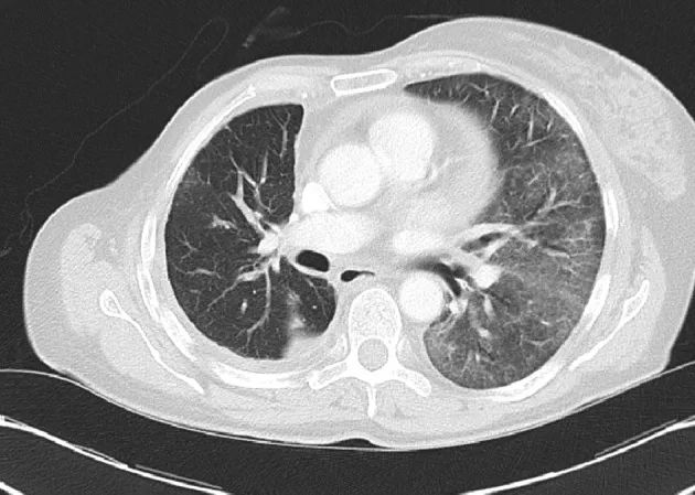 A patient, who was diagnosed with Breast Adenocarcinoma