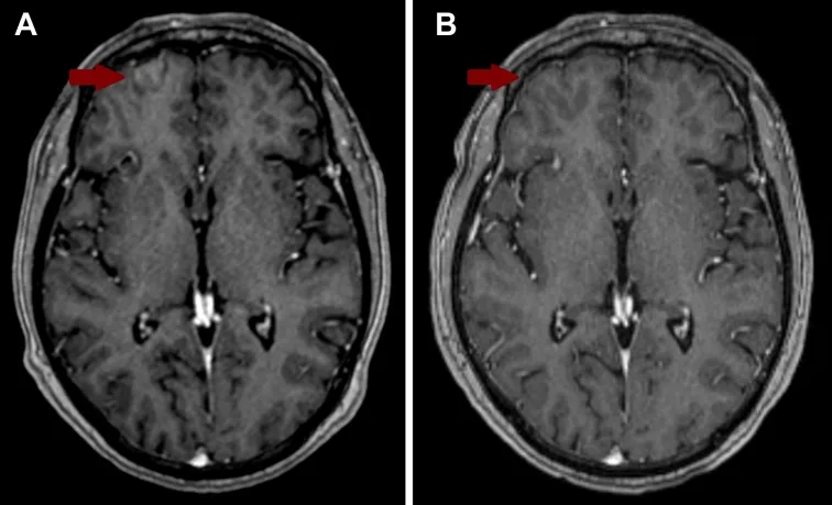 A patient, who was diagnosed with Stage IV Non-Small Cell Lung Cancer