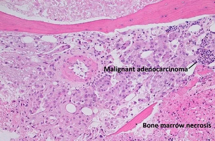 A patient, who was diagnosed with Lung Adenocarcinoma