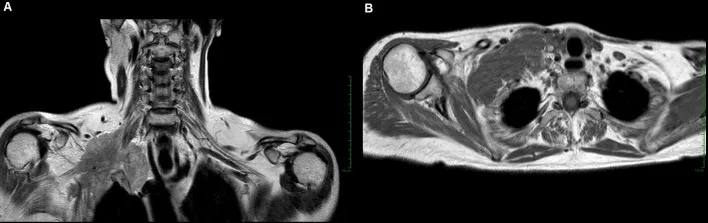 A patient, who was diagnosed with Inflammatory Breast Cancer