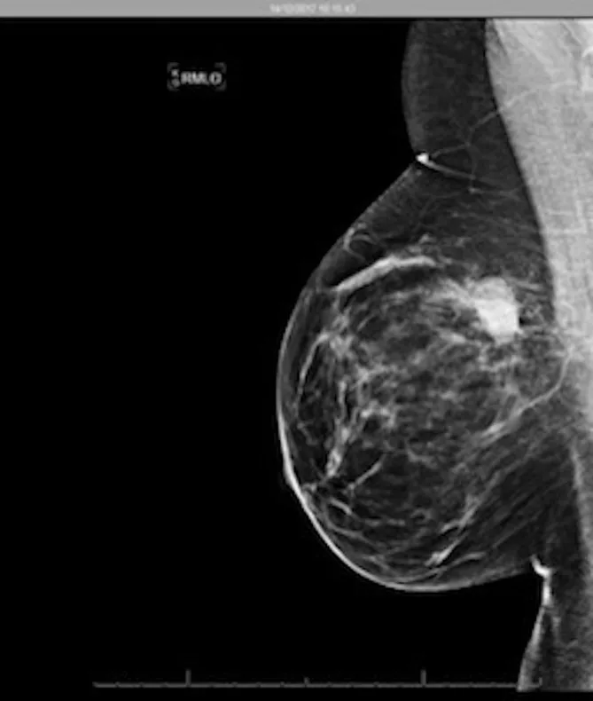 A patient, who was diagnosed with Breast Cancer