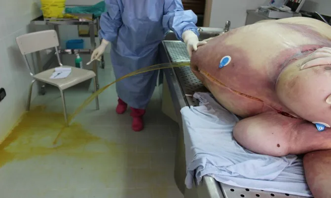 A patient, who was diagnosed with Stage IV Ovarian Adenocarcinoma