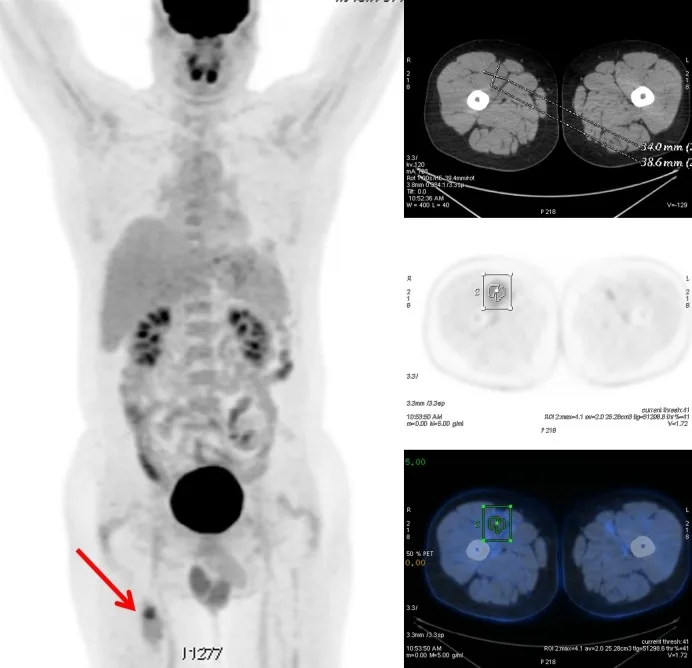 A patient, who was diagnosed with Colorectal Adenocarcinoma