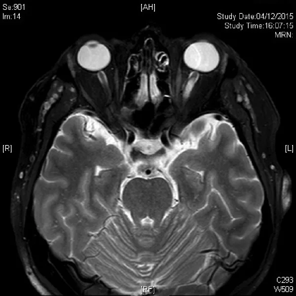 A patient, who was diagnosed with Colorectal Adenocarcinoma