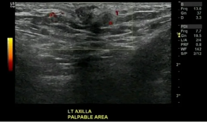 A patient, who was diagnosed with Invasive Ductal Carcinoma