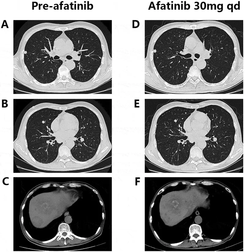 A patient, who was diagnosed with Stage IV Colorectal Adenocarcinoma