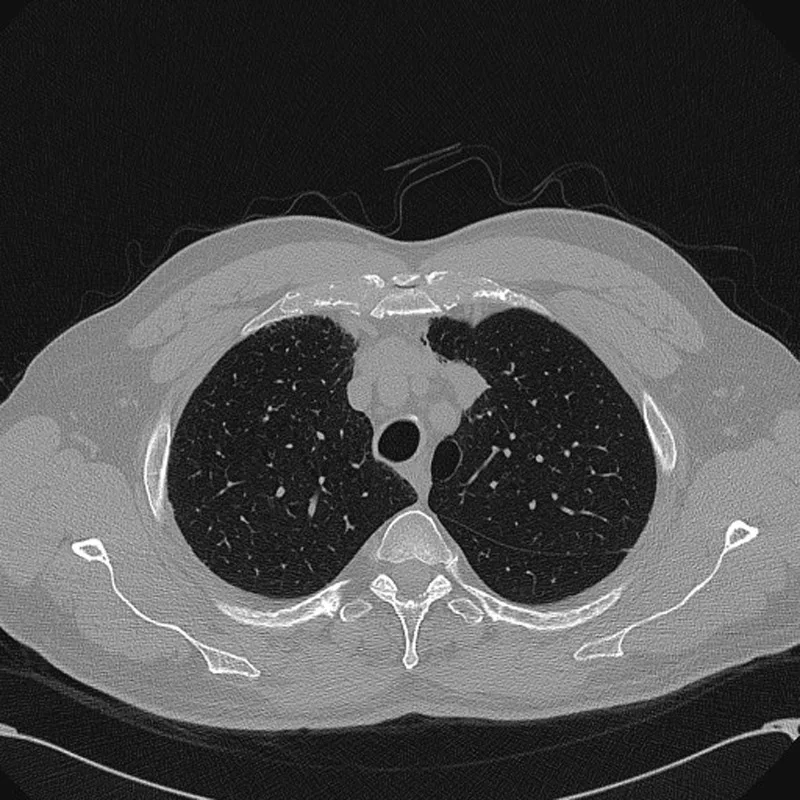 A patient, who was diagnosed with Lung Adenocarcinoma