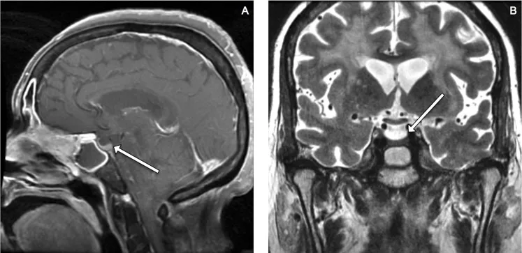 A patient, who was diagnosed with Stage IV Lung Adenocarcinoma