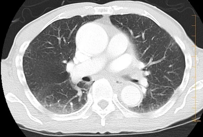 A patient, who was diagnosed with Stage IV Colorectal Adenocarcinoma