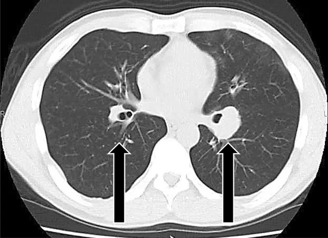 A patient, who was diagnosed with Small Cell Lung Cancer