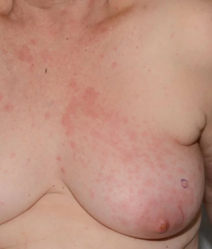 A patient, who was diagnosed with Breast Cancer