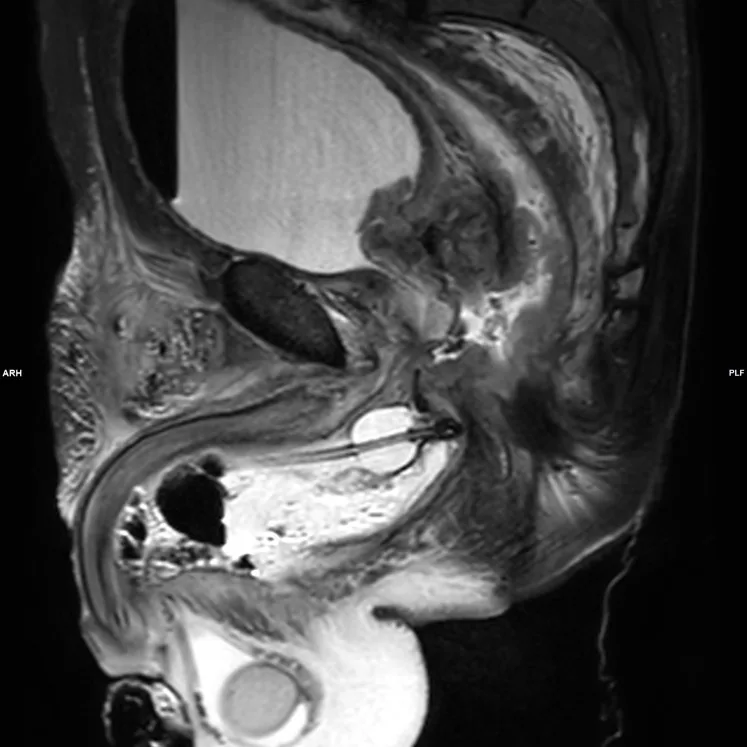 A patient, who was diagnosed with Colorectal Adenocarcinoma