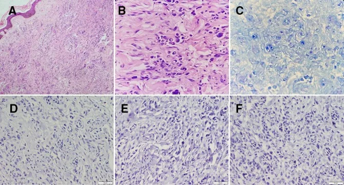A patient, who was diagnosed with Gastric Adenocarcinoma