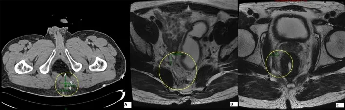 A patient, who was diagnosed with Colorectal Cancer