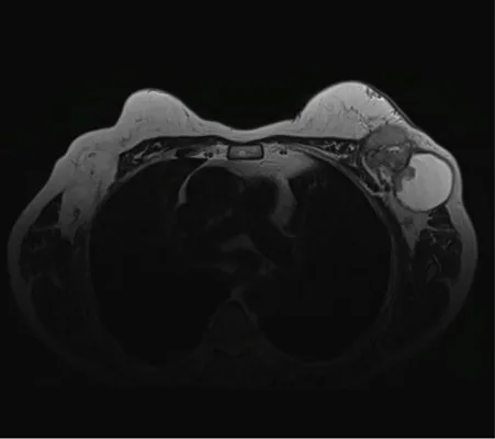 A patient, who was diagnosed with Invasive Ductal Carcinoma