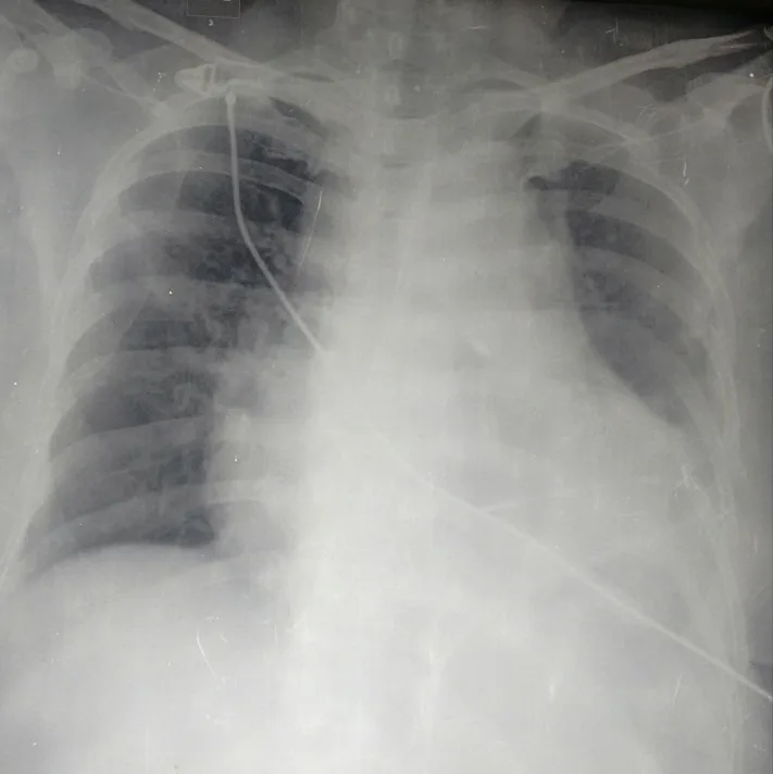 A patient, who was diagnosed with Ovarian Cancer