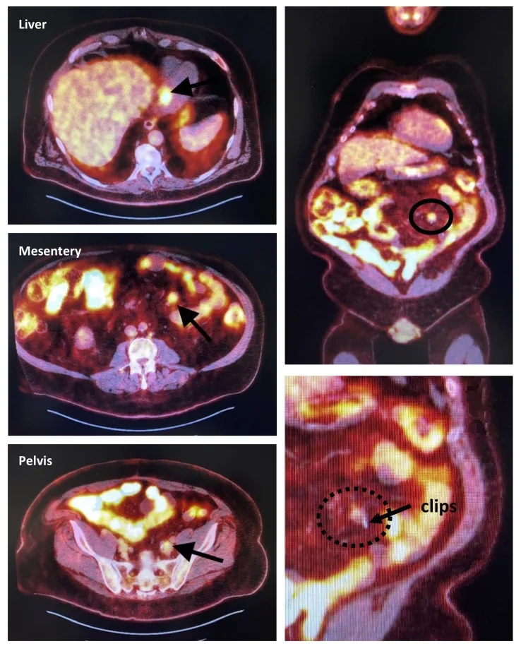 A patient, who was diagnosed with Colorectal Adenocarcinoma