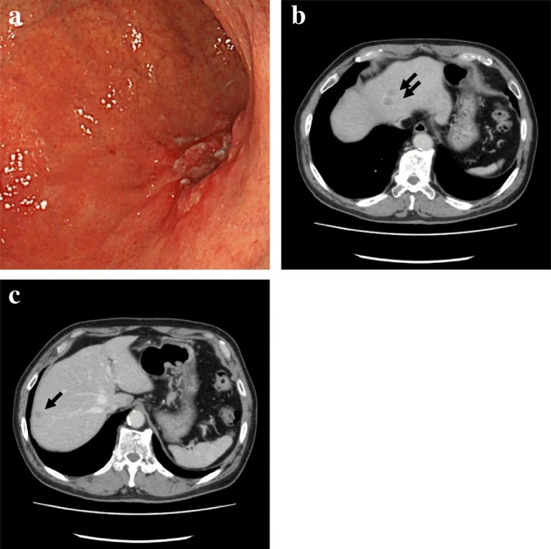 A patient, who was diagnosed with Stage IV Gastric Cancer