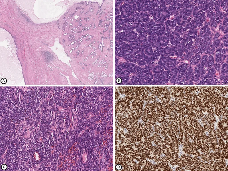 A patient, who was diagnosed with Ovarian Cancer