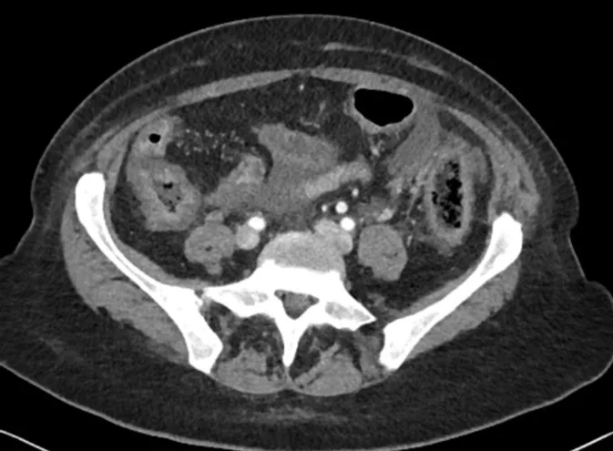 A patient, who was diagnosed with Lung Adenocarcinoma