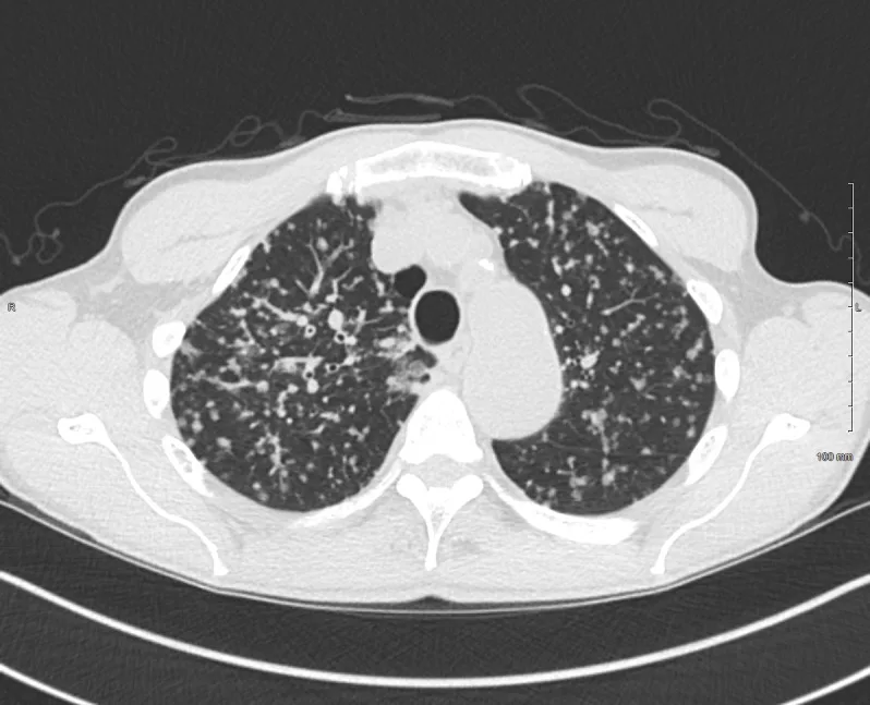 A patient, who was diagnosed with Stage IV Lung Adenocarcinoma