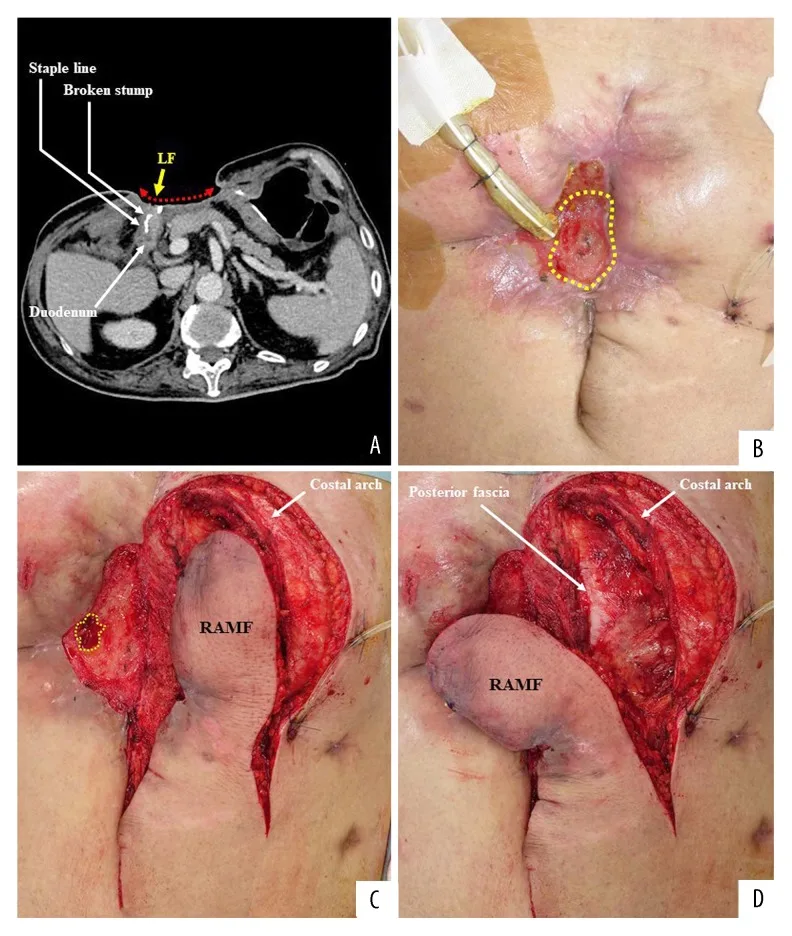 A patient, who was diagnosed with Stage III Gastric Cancer