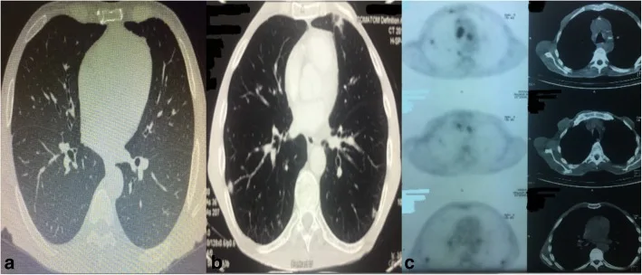 A patient, who was diagnosed with Stage IV Gastric Squamous Cell Carcinoma