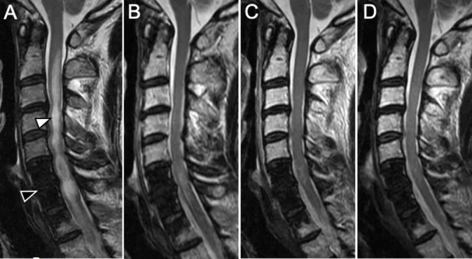 A patient, who was diagnosed with Stage IV Lung Adenocarcinoma