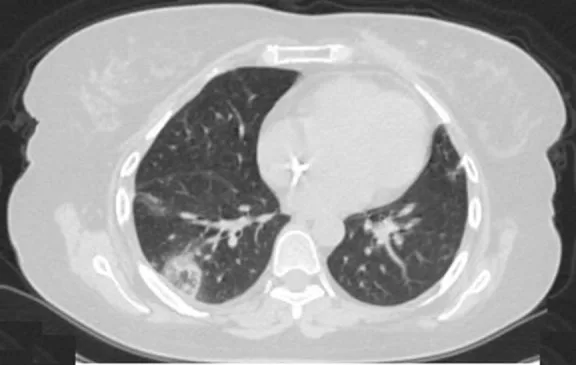 A patient, who was diagnosed with Stage III Invasive Ductal Carcinoma